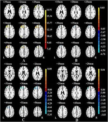 Gray matter reduction is associated with cognitive dysfunction in depressed patients comorbid with subclinical hypothyroidism